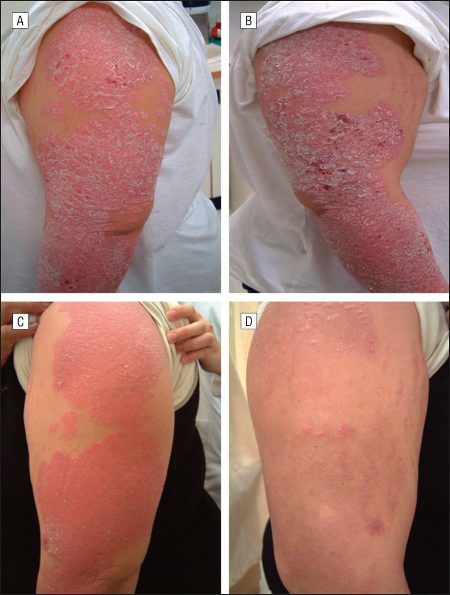 psoriasis